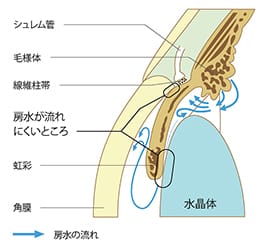 原発閉塞隅角緑内障