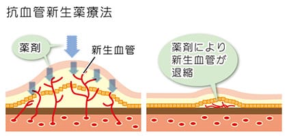 抗血管新生薬療法