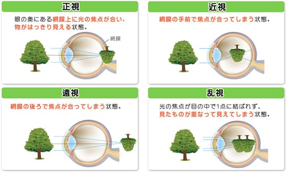 屈折異常とは